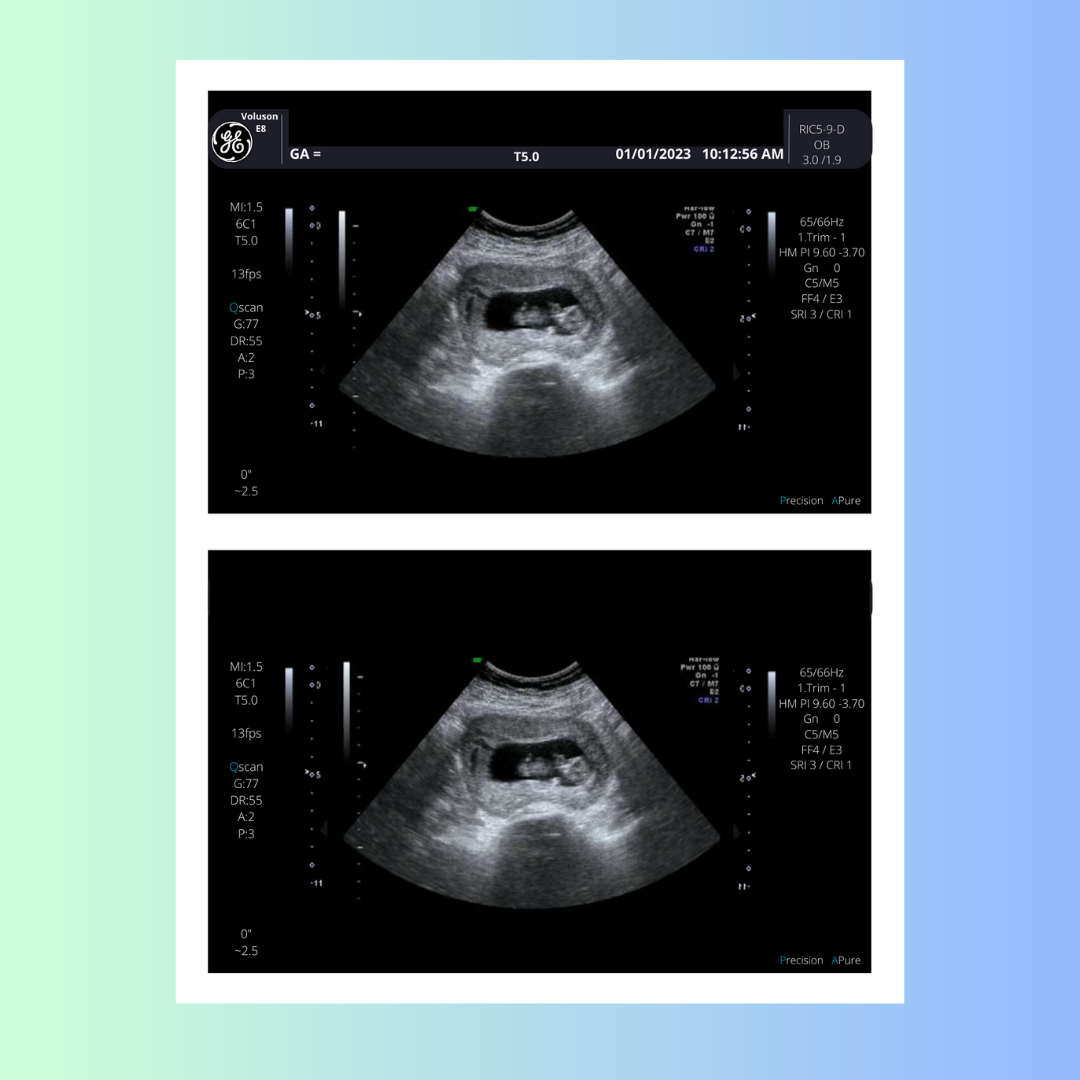 6 Weeks Pregnant Ultrasound Picture