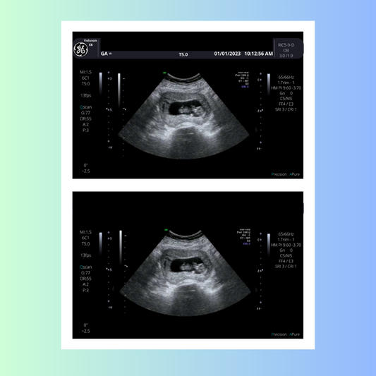 6 Weeks Pregnant Ultrasound Picture
