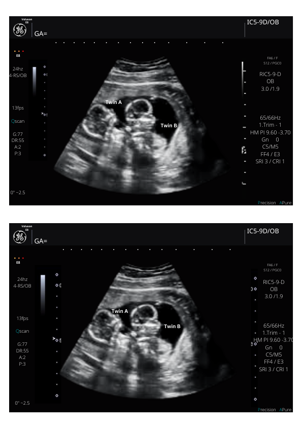 Twins Fake Sonogram Picture!! From 3-40 weeks! | Customizable Digital Twin Ultrasound Picture  |