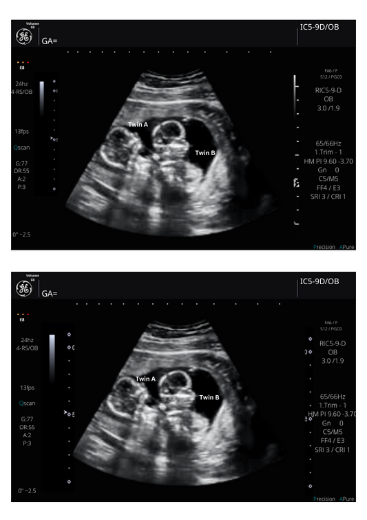 Twins Fake Sonogram Picture!! From 3-40 weeks! | Customizable Digital Twin Ultrasound Picture  |