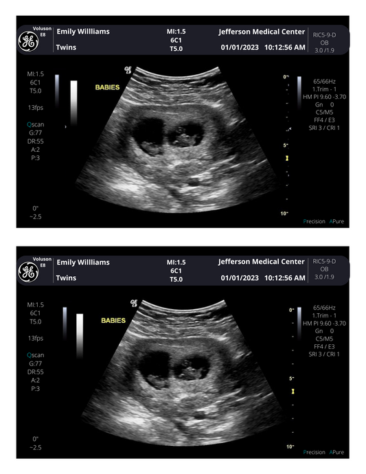 Twins Fake Sonogram Picture!! From 3-40 weeks! | Customizable Digital Twin Ultrasound Picture  |