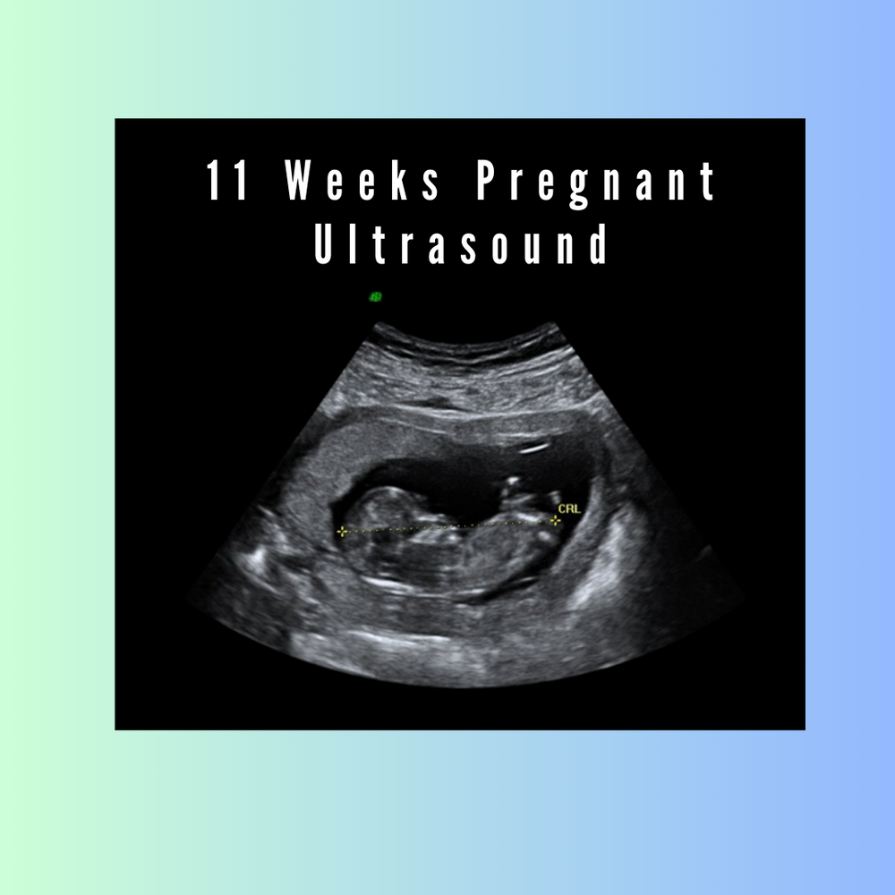 Ultrasounds Blog Posts: From 1-12 Weeks Pregnancy Scan – creetify