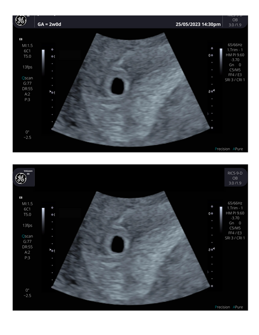 4 weeks pregnant ultrasound