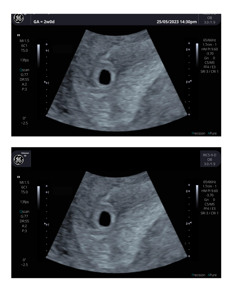 4 Weeks Pregnant Ultrasound Your First Glimpse into Pregnancy creetify