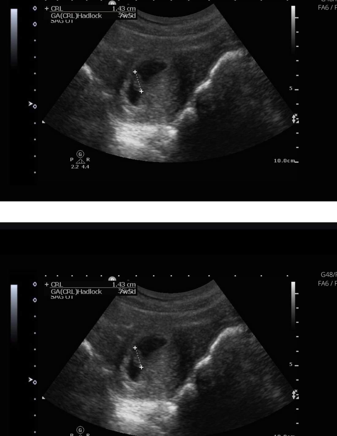 5 weeks pregnant ultrasound