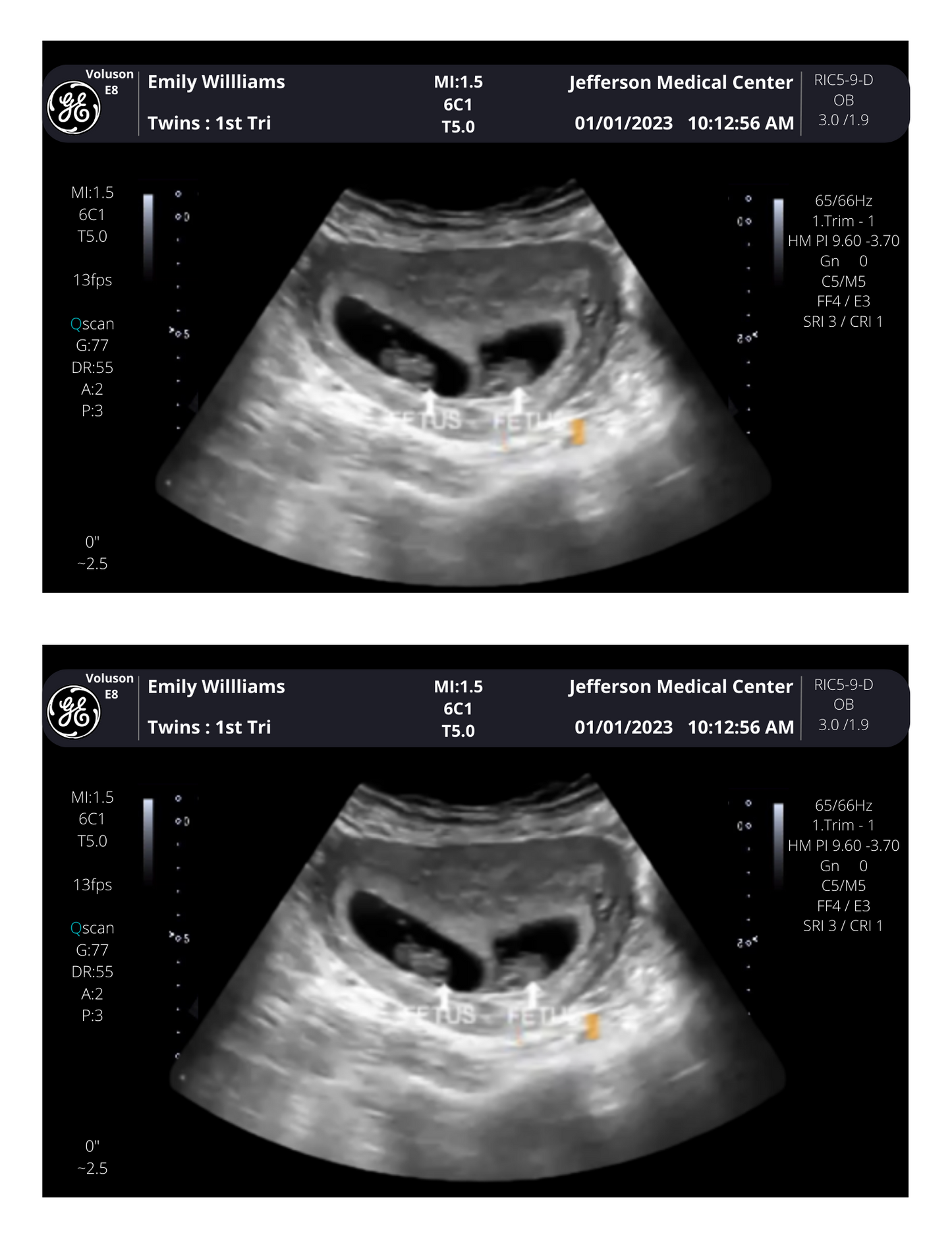 Fake Twins Ultrasound Picture !! From 3-40 weeks! | Customizable Digital Twin Sonogram Picture |