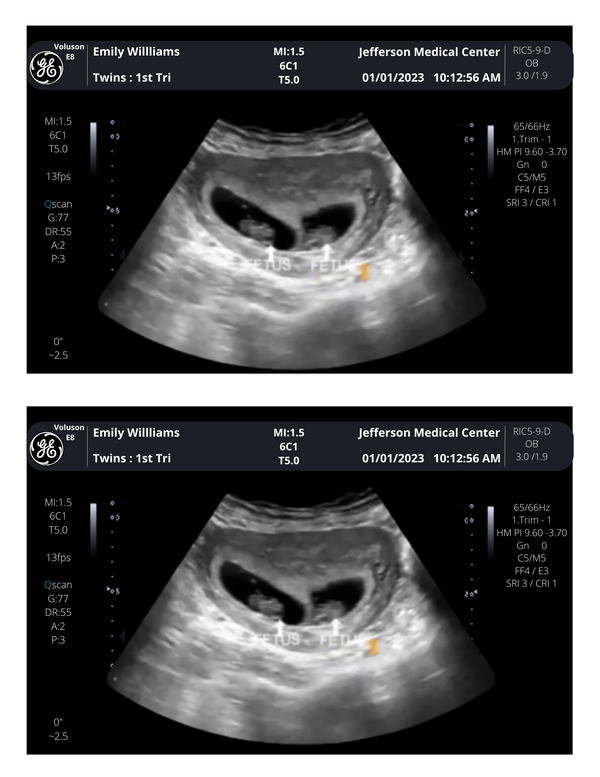 Fake Twins Ultrasound Picture !! From 340 weeks! Customizable Digit