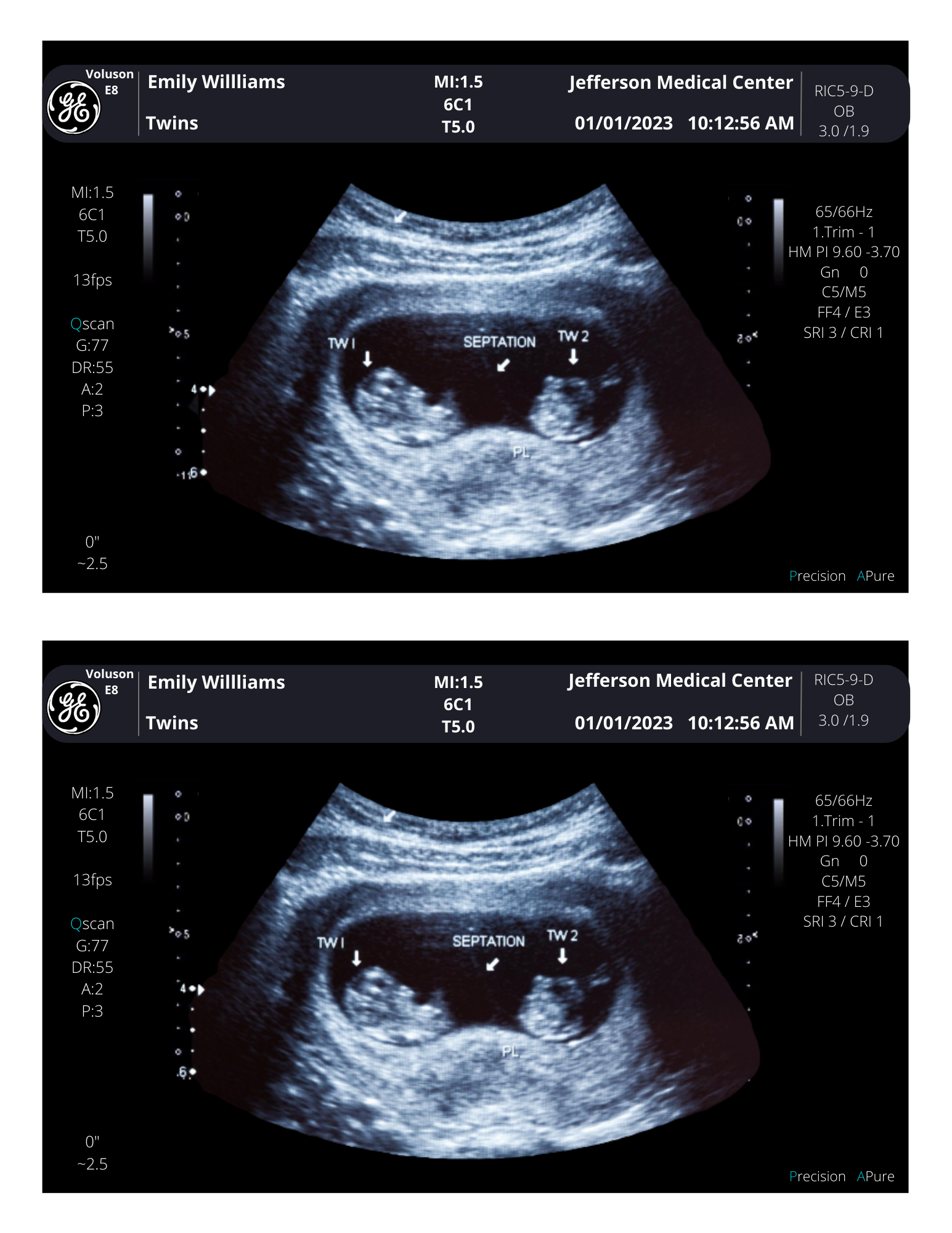 identical twins ultrasound 10 weeks